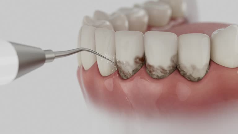 Trusted Wisdom Tooth Removal service in Newport Beach, CA - Dentist Open Now